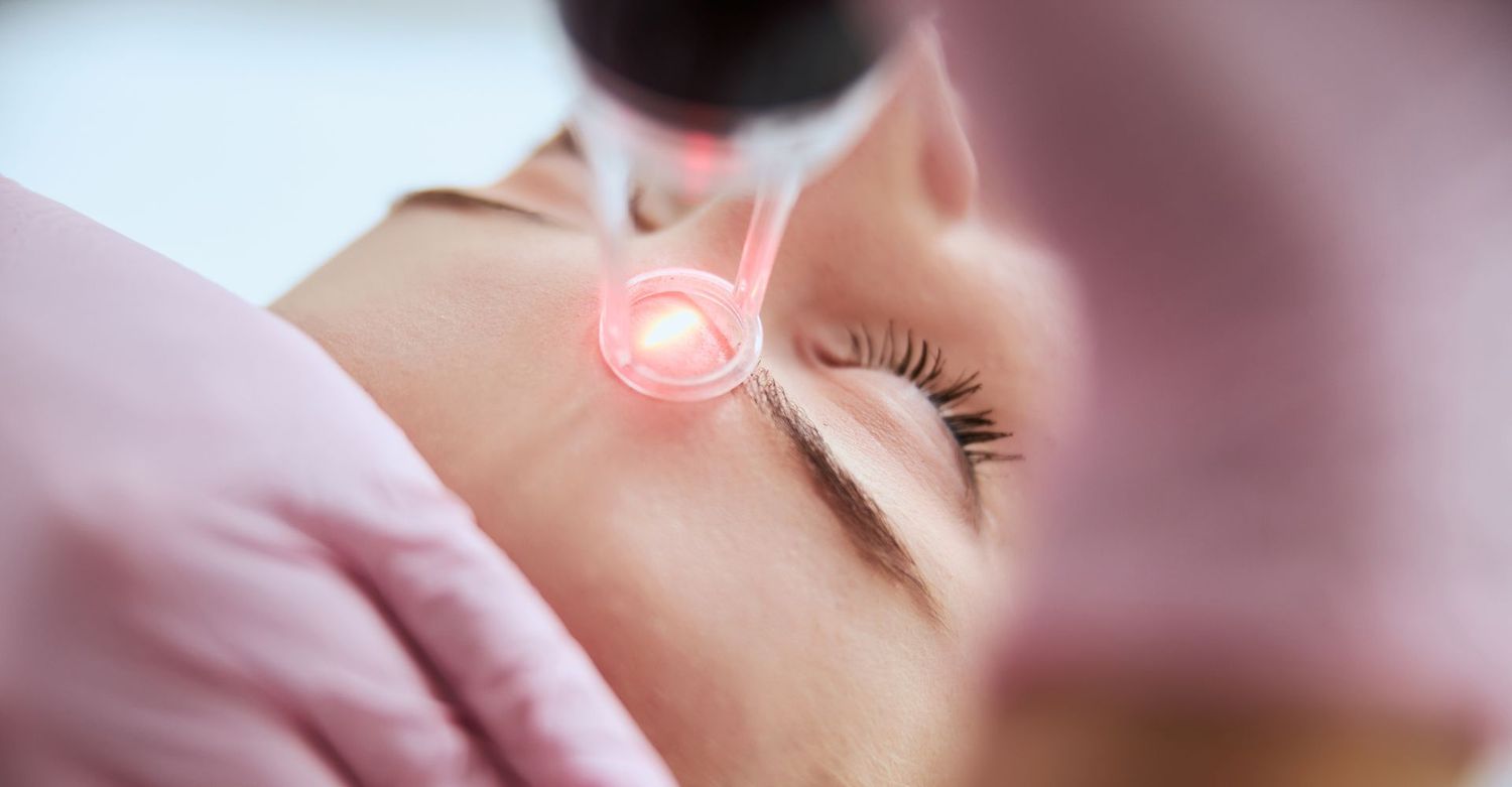 Facial treatment using a laser device.