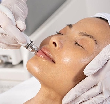 Microneedling facial treatment in progress.