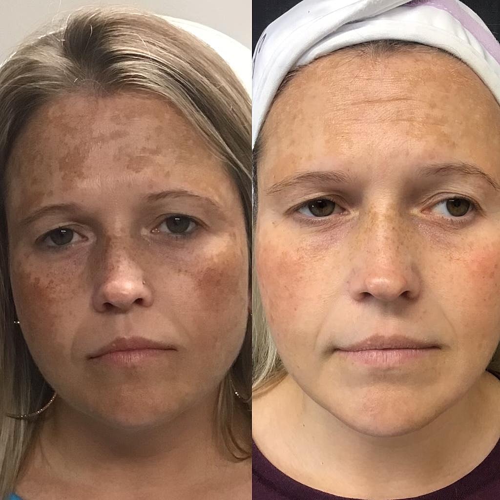 Skin treatment before and after comparison photos.