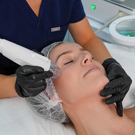 Facial treatment with a microneedling device.