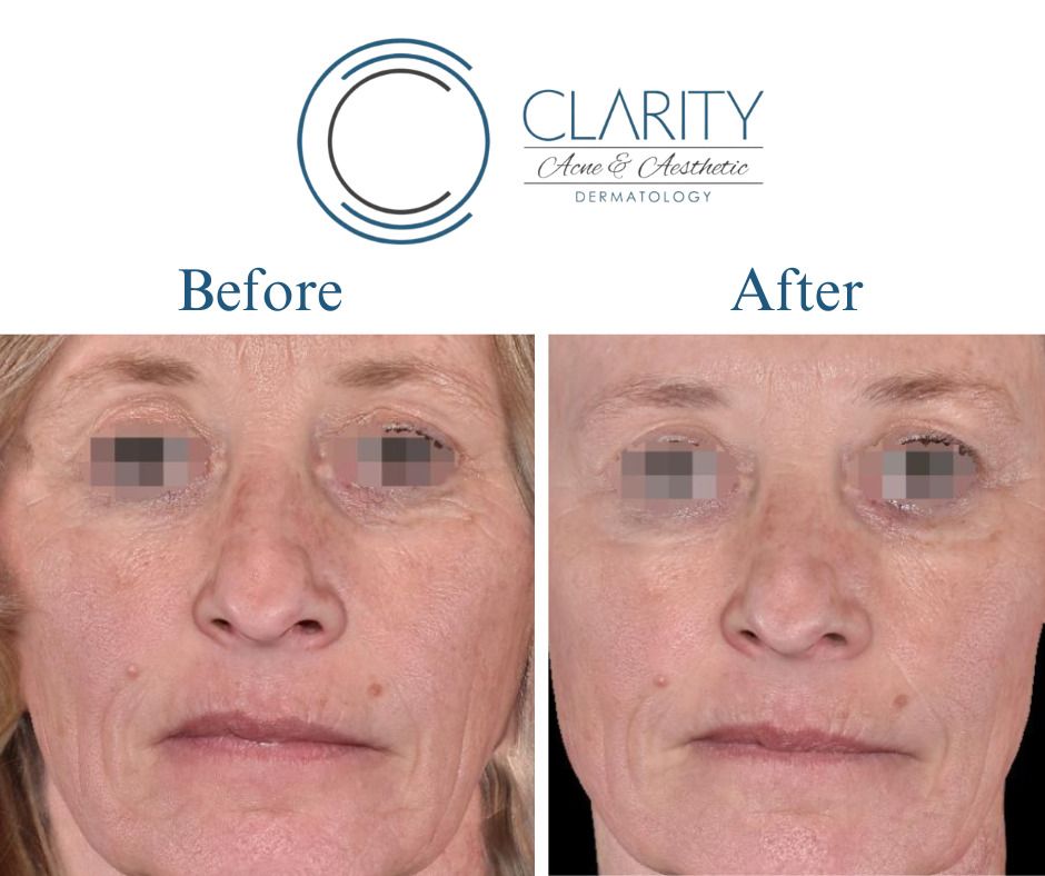 Dermal Filler Before & After