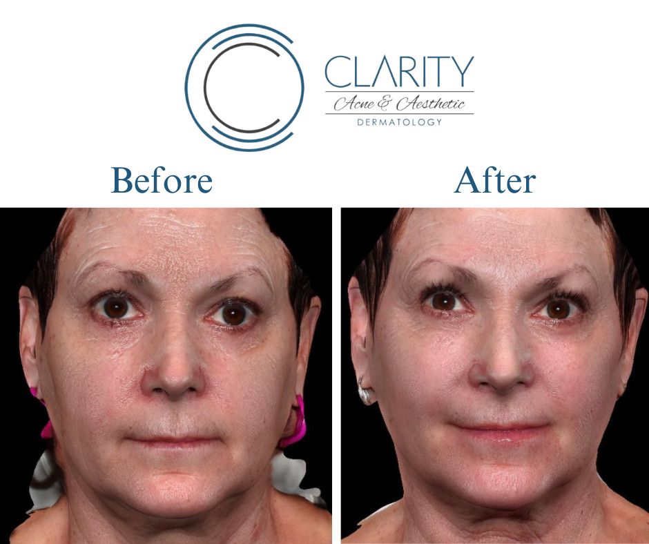 Dermal Filler Before & After