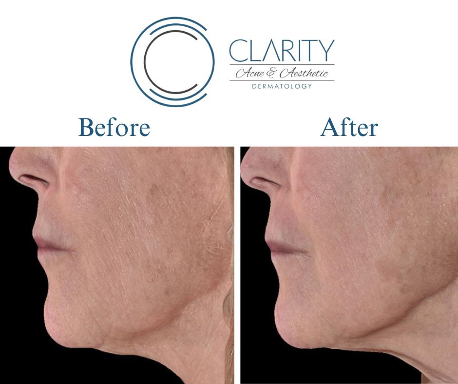 Kybella Before & After