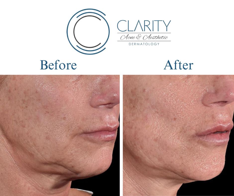 Pdo Threads Before & After