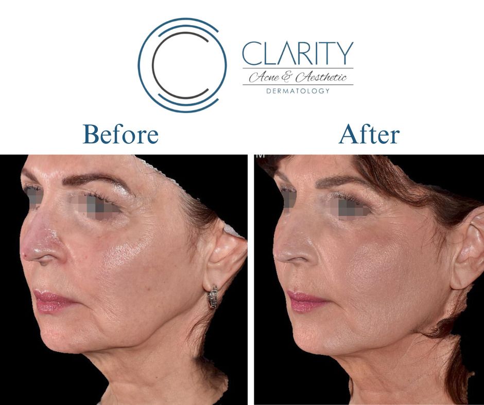 Pdo Threads Before & After