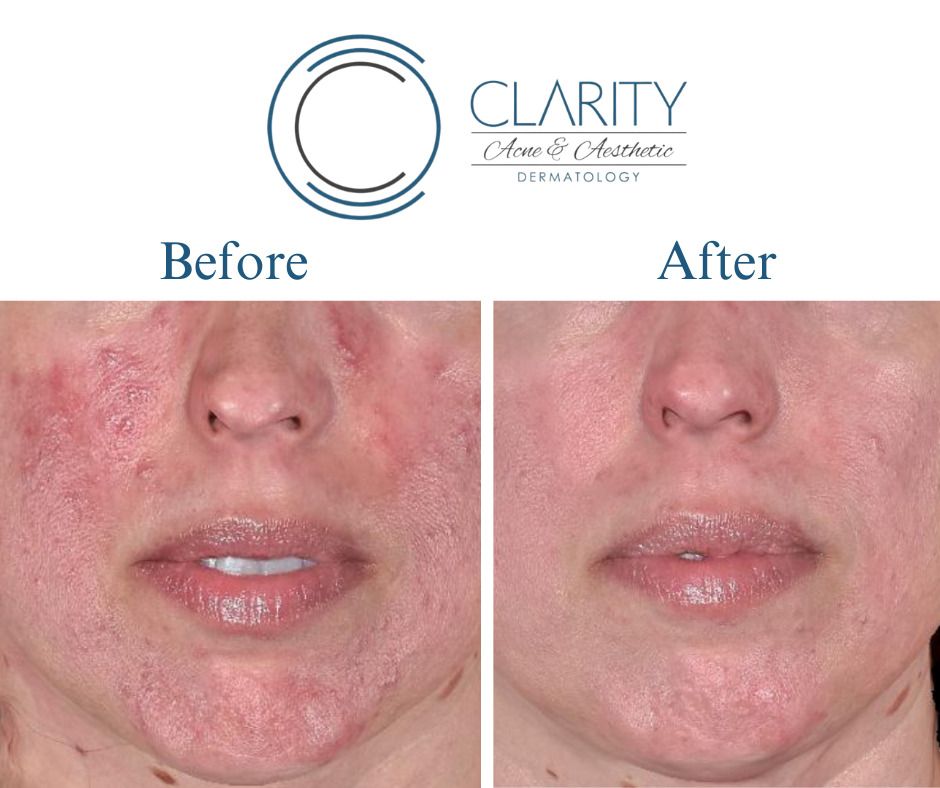 Aerolase Before & After