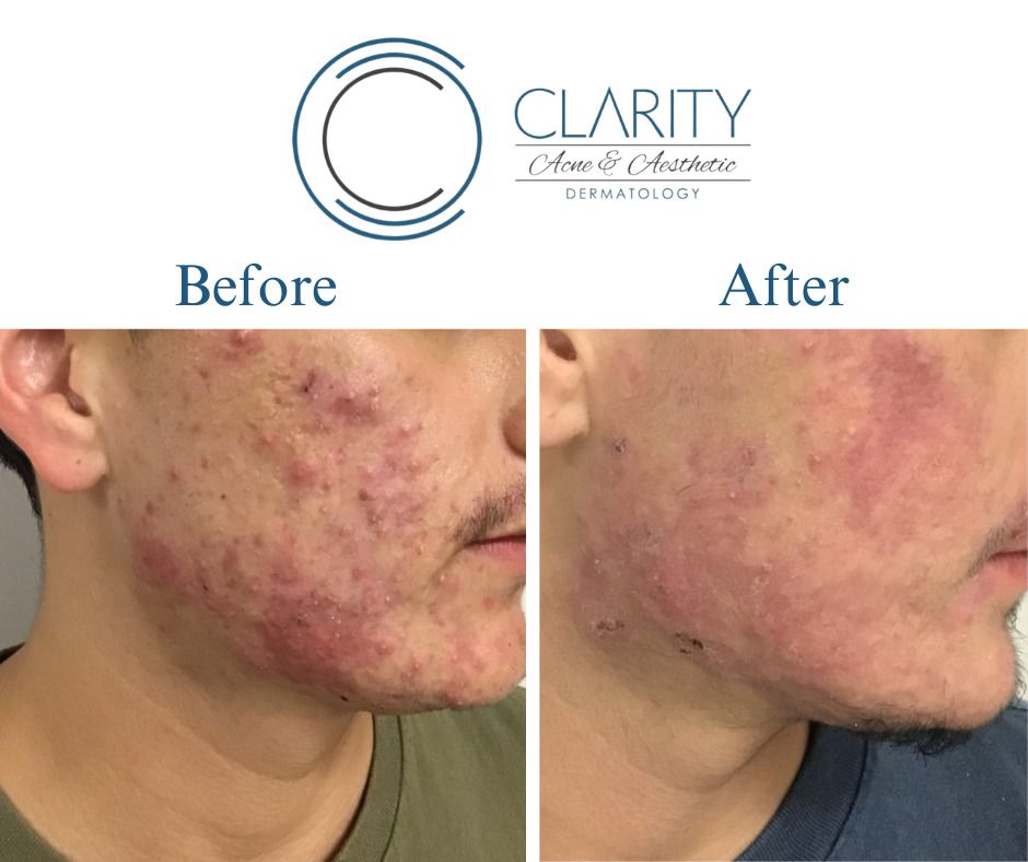 Isotretinoin With Aerolase Before & After