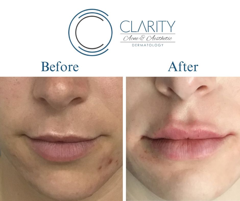 Lip Filler Before & After