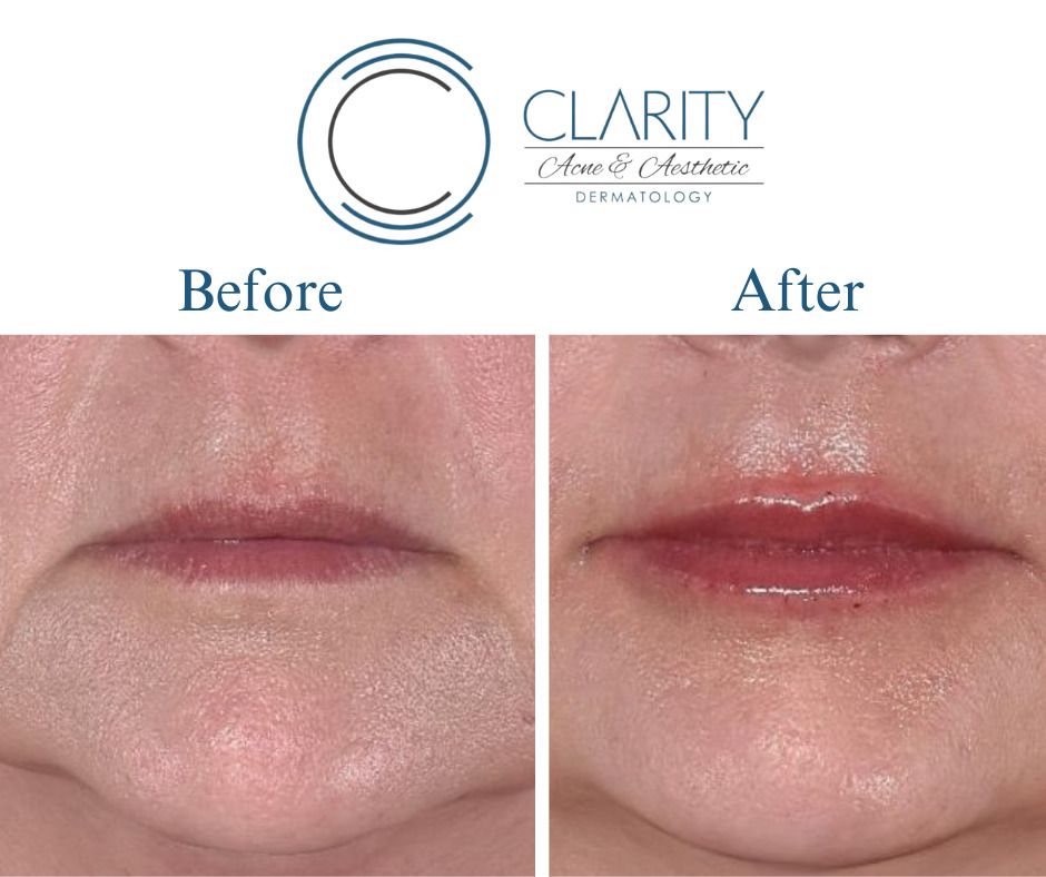 Lip Filler Before & After