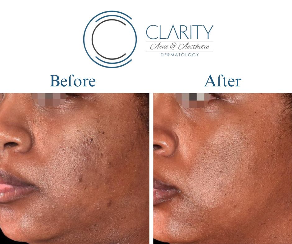 Vi Peel Before & After