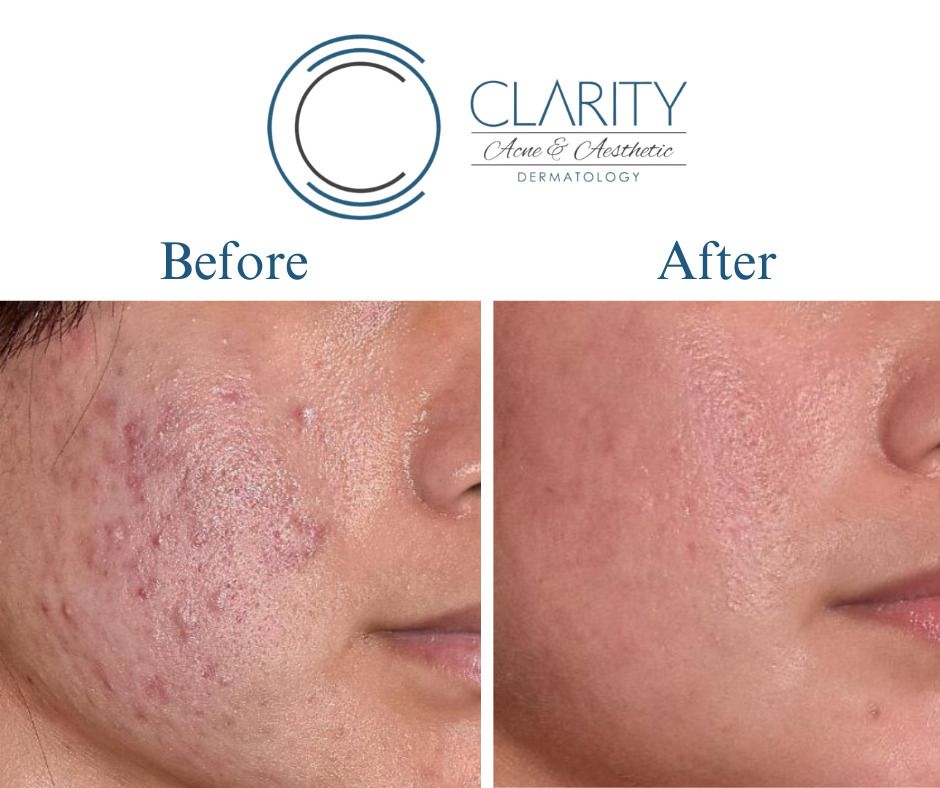 Vi Peel Before & After